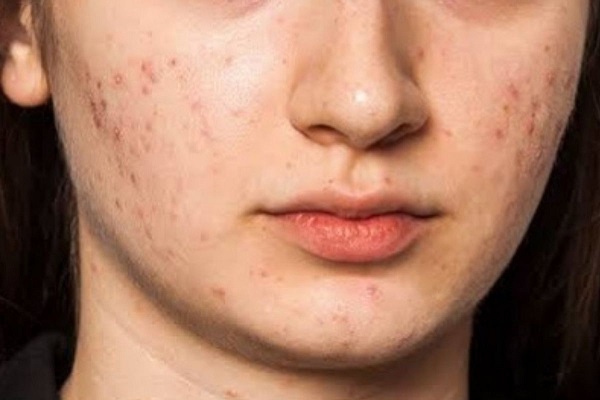 Want to remove facial spots, try these easy solutions